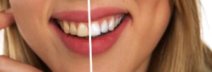 How Long Can You Keep Your Teeth with Periodontal Disease?